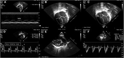 Hemodynamics in neonates with polycythemia before and after partial exchange transfusion: an observational study